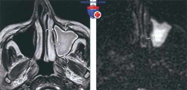 КТ, МРТ при хроническом риносинусите