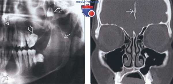Лучевая диагностика синдрома базальноклеточного невуса челюсти