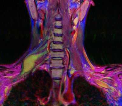 невринома плечевого сплетения в цвете