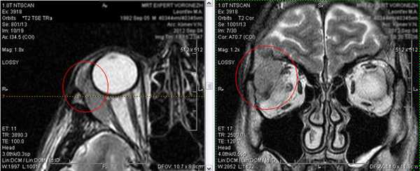  Применение МРТ при заболеваниях глаз