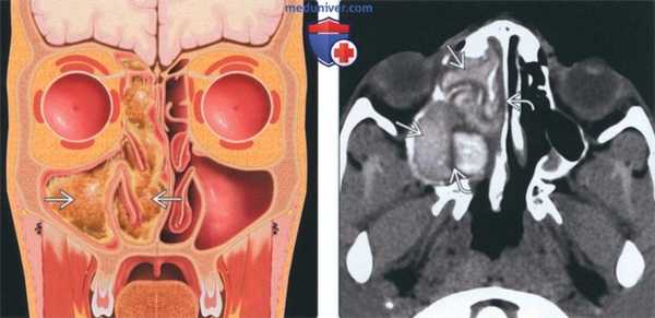 Лучевая диагностика аллергического грибкового синусита
