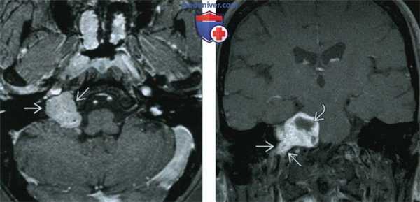 КТ, МРТ при шванноме яремного отверстия
