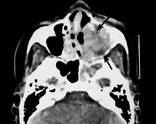 Компьютерная томограмма носовых пазух: правосторонний гайморит