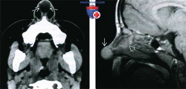 КТ, МРТ при дермальном синусе носа