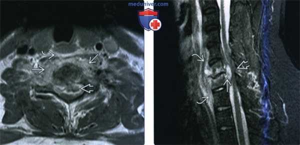 КТ, МРТ при флегмоне паравертебрального пространства