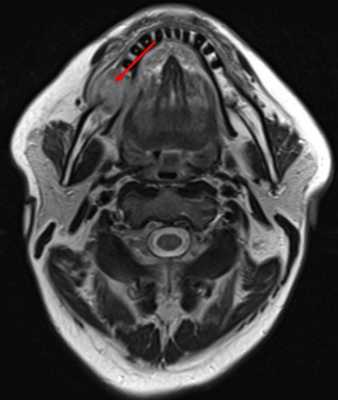Рис.3 МРТ с внутривенным контрастированием