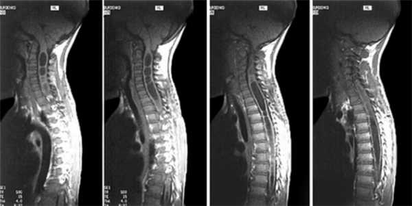 Снимок МРТ при опухоли позвоночника