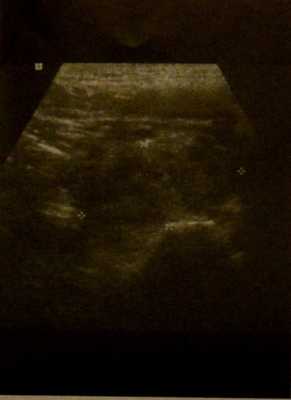 Снимки МРТ и КТ. Заглоточный абсцесс у ребенка