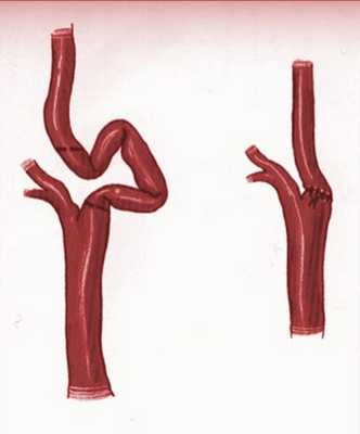 Резекция с редрессацией внутренней сонной артерии