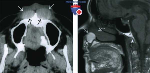 Носогубная киста - лучевая диагностика