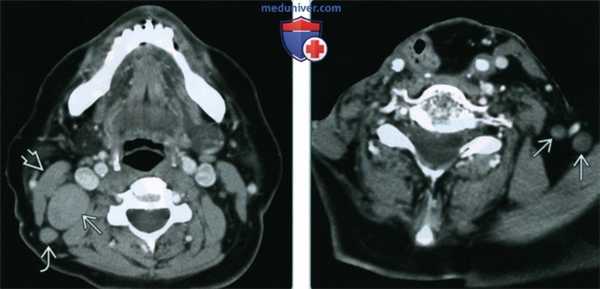 Метастазы плоскоклеточного рака в лимфоузлы добавочной цепи - лучевая диагностика