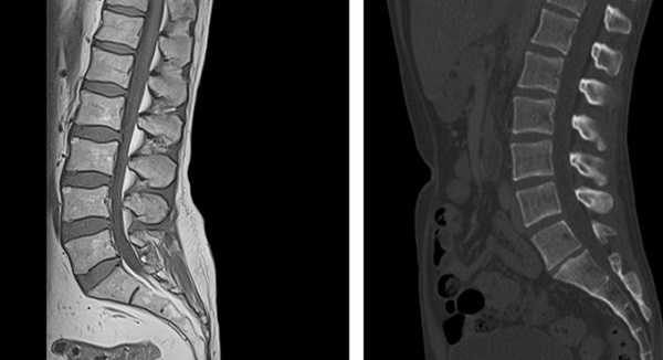 МР- и КТ- снимки поясничного отдела позвоночника