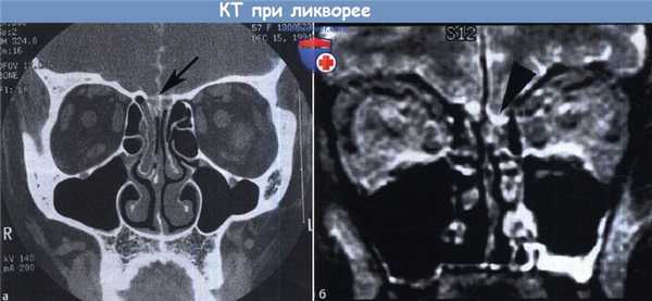 КТ при ликворее