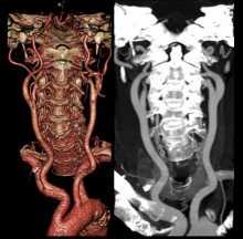 КТ и МРТ позвоночника 