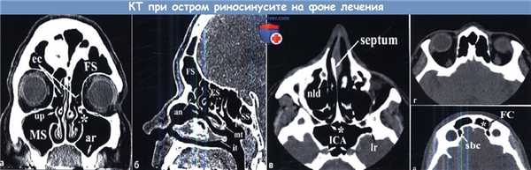 КТ при остром риносинусите