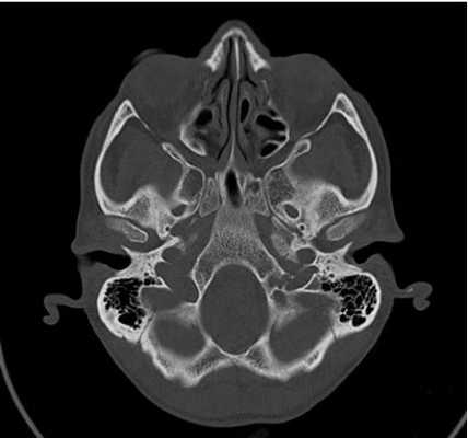 Хондросаркома
