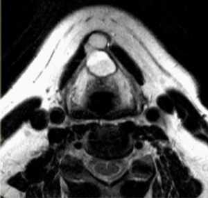 щитовидно-подъязычный проток-МРТ