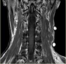 лимфангиома-обр