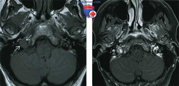 КТ, МРТ при шванноме яремного отверстия