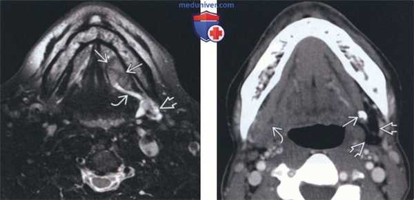 Лучевая диагностика поднижнечелюстного сиаладенита