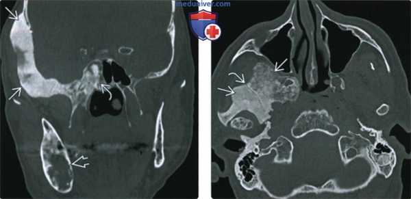 КТ, МРТ при фиброзной дисплазии основания черепа