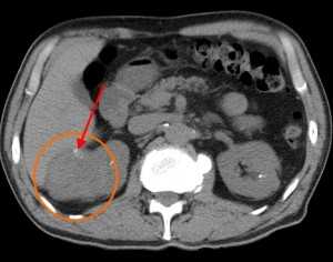 РАК_ПОЧКИ_НАТИВ (1)
