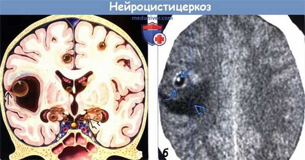 Нейроцистицеркоз на КТ