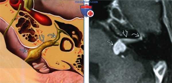 Шваннома лицевого нерва мостомозжечкового угла (ММУ) и внутреннего слухового канала (ВСК) - лучевая диагностика