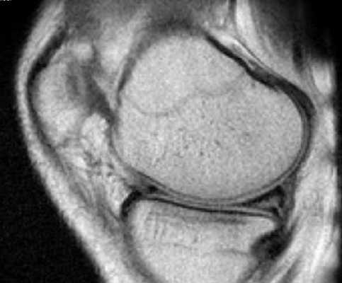 Разрыв заднего рога медиального мениска на снимке МРТ