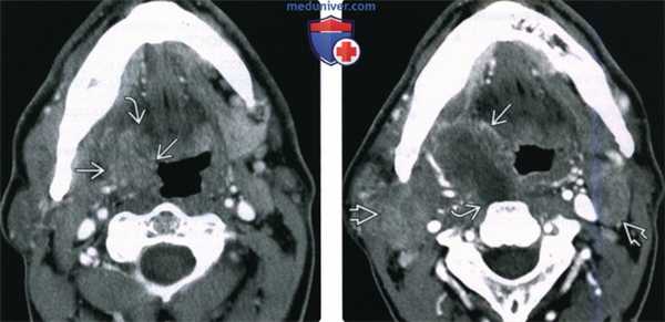 КТ, МРТ при плоскоклеточном раке небной миндалины