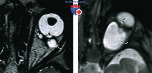 КТ, МРТ при колобоме
