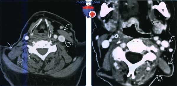 Гипертрофия мышцы поднимающей лопатку - лучевая диагностика