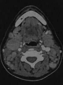 Снимки МРТ и КТ. Лимфома лимфатических узлов