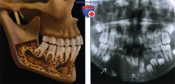 Синдром базального клеточного невуса - лучевая диагностика