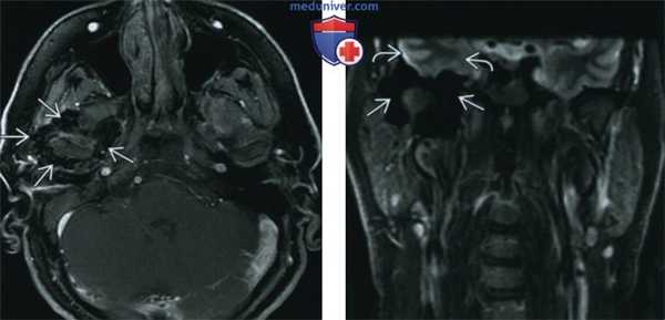 Пигментный ворсинчато-узелковый синовит височно-нижнечелюстного сустава (ВНЧС) - лучевая диагностика