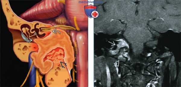 Менингиома яремного отверстия - лучевая диагностика