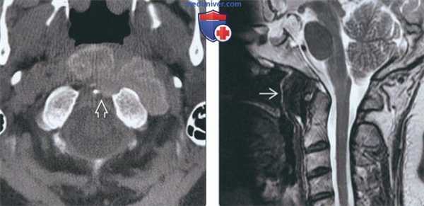Лучевая диагностика туморального кальциноза