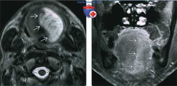 Моторная денервация подъязычного нерва - лучевая диагностика