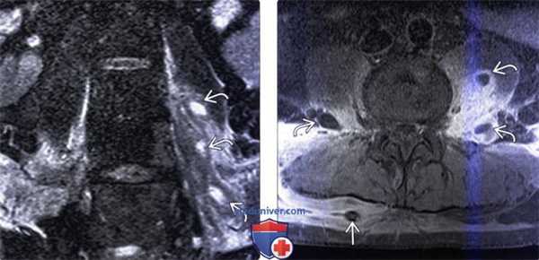 КТ, МРТ при паравертебральном абсцессе