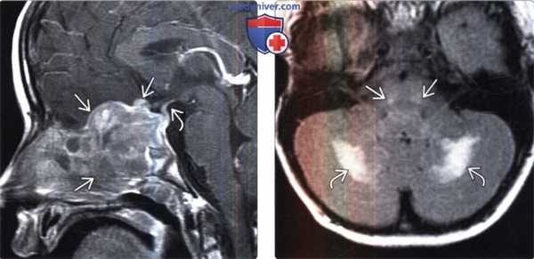 МРТ головы при гистиоцитозе из клеток Лангерганса