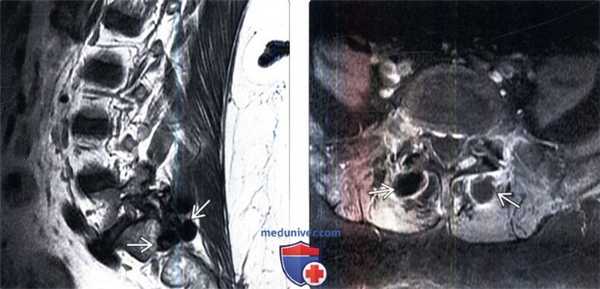 КТ, МРТ при опухолевом кальцинозе позвоночника