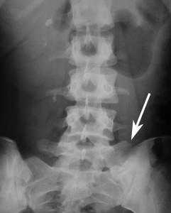 bertolotti syndrome_xray