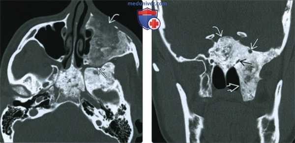 КТ, МРТ при фиброзной дисплазии основания черепа