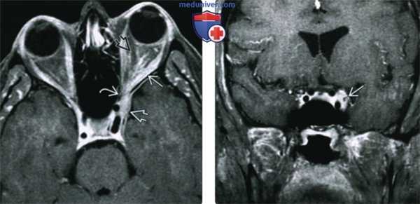 КТ, МРТ при внутричерепном идиопатическом воспалительном псевдотуморе
