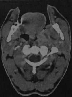 Снимки МРТ и КТ. Перитонзилярный абсцесс