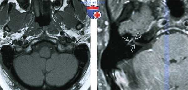 КТ, МРТ при параличе Белла