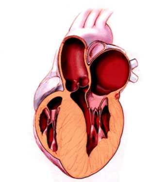 Фото Гипертрофия