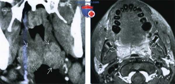Воспаление небных миндалин - лучевая диагностика