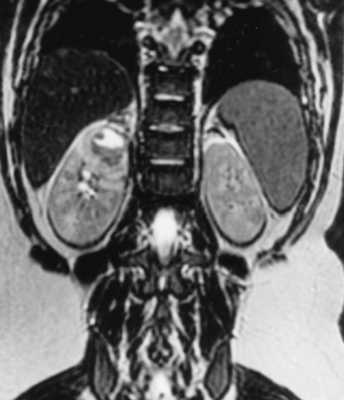 абсцесс почки