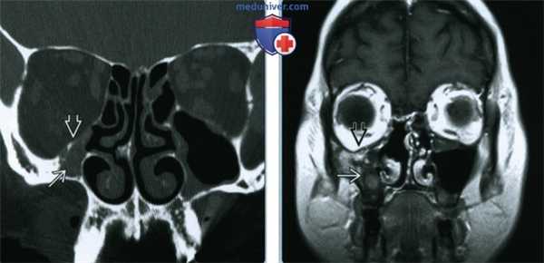 Синдром немой пазухи - лучевая диагностика